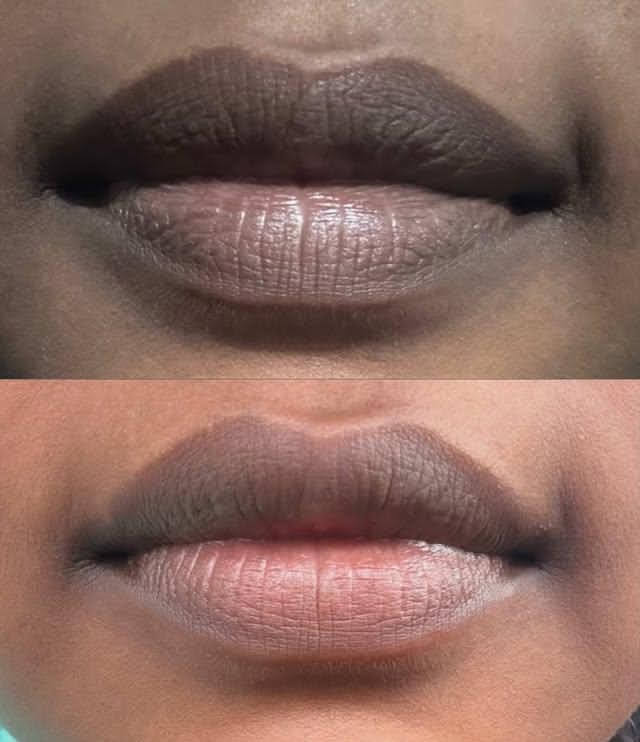 Deep Hyperpigmentation Reversal to Natural Rosy Pink